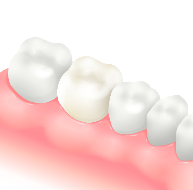 オールセラミックインレー　オールセラミッククラウン