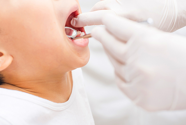 フッ素塗布(フッ素化物)